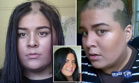 فتاة تستيقظ لتجد نفسها صلعاء