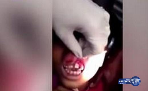 بالفيديو : لحظة استخراج 15 دودة من لثة طفلة