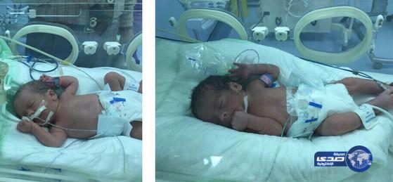 ولادة ثلاثة توائم بمستشفى الامام عبدالرحمن الفيصل (صور)