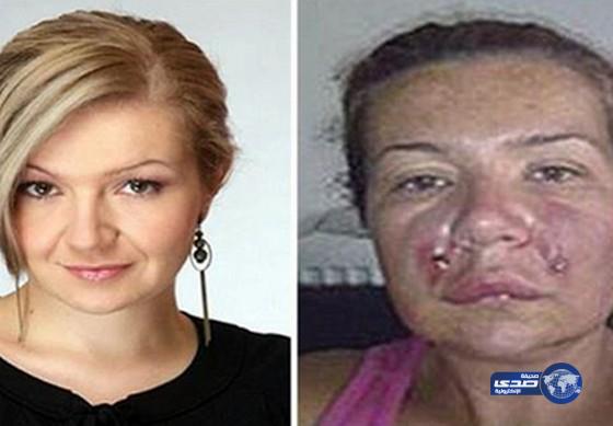 عملية تجميل فاشلة تشوه وجه نجمة تلفزيونية بوسنية ‏