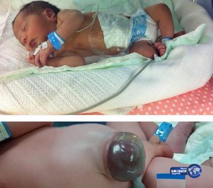 أنقاذ مولود يعاني من بزوغ الكبد في حالة نادرة