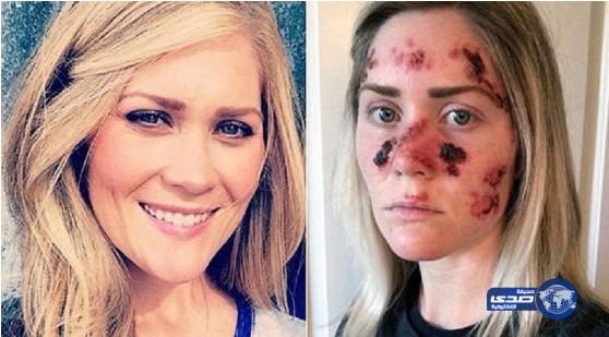 فتاة مصابة بسرطان الجلد تنشر صورها للتوعية من خطورة “كريمات تسمير البشرة”