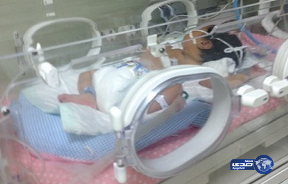 فريق طبي يتمكن من إنقاذ حياة مولود يعاني من فتق في الحاجب الحاجز بالجوف