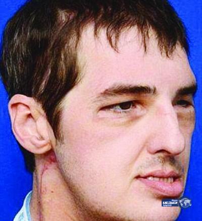 نجاح زراعة وجه كامل لرجل فقد ملامحه في حادث مأساوي