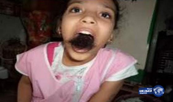 استخراج 125 غراما من الشعر بمعدة طفلة استرالية