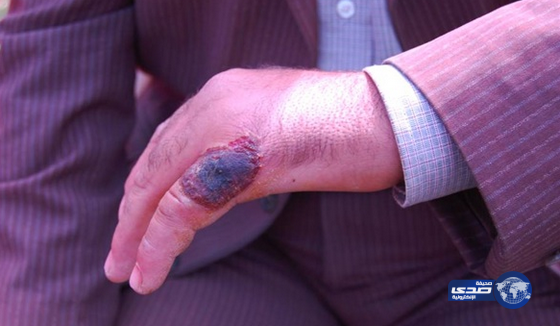 اكتشاف خمس حالات إصابة بمرض الجمرة الخبيثة بإحدى قرى تركيا