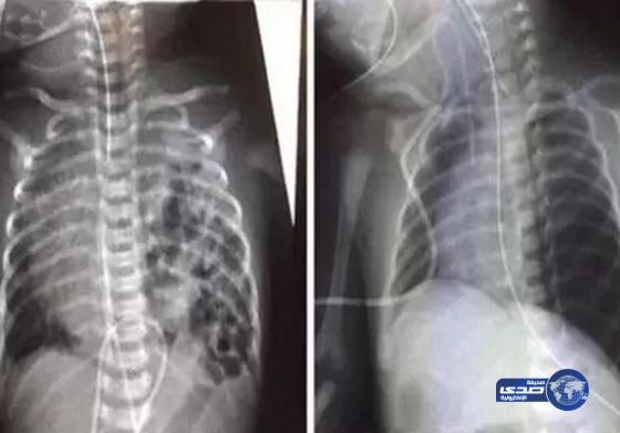 بالصور: طفلة تولد بمعدة وأمعاء داخل معدتها