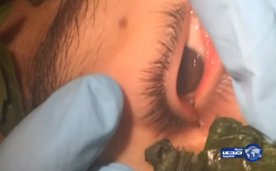 بالفيديو… أطباء يستخدمون أوراق الريحان لانتزاع “دودة” من عين مراهق