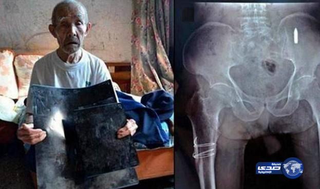 صيني “ليس لديه أي فكرة” عن رصاصة في جسده منذ 70 عاما