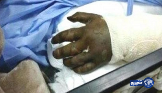 إدانة طبيبين وأخصائي تخدير في قضية الفتاة “مبتورة اليد” بمحايل عسير