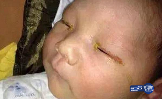 «فلاش» جوال يصيب رضيعاً بالعمى (صورة)