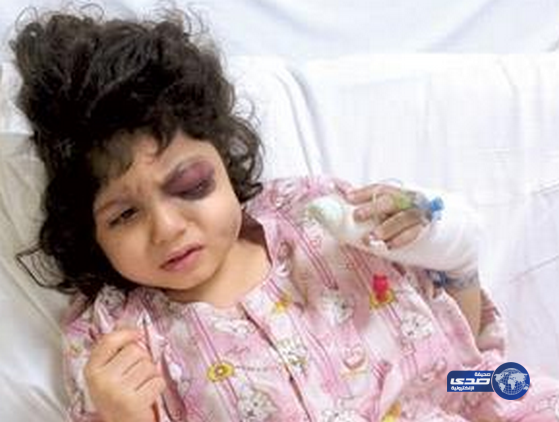استخراج الرصاصة من رأس الطفلة السعودية &#8220;زينب&#8221; بعد جراحة استمرت لأكثر من ساعتين