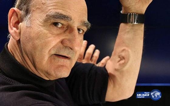 بالفيديو: فنّان يزرع أذناً في ذراعه ليوصلها عبر الإنترنت