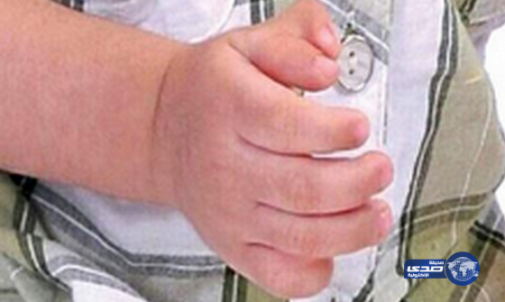 «صحة الشرقية» تُحيل شكوى بتر إصبع طفل إلى الهيئة الشرعية