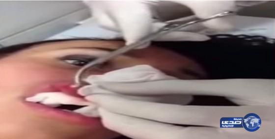 بالفيديو: إخراج يرقة حية من شفة شابة بريطانية