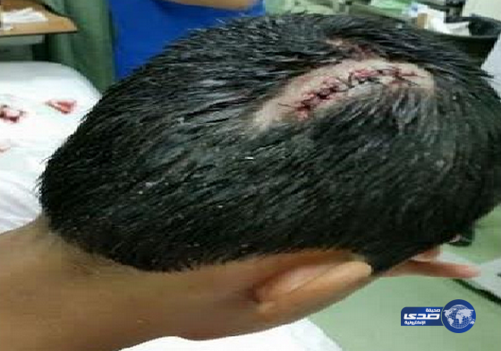 مواطن يتنازل عن مقاضاة خادمة أصابت ابنه بجرح استلزم 9 غرز في رأسه