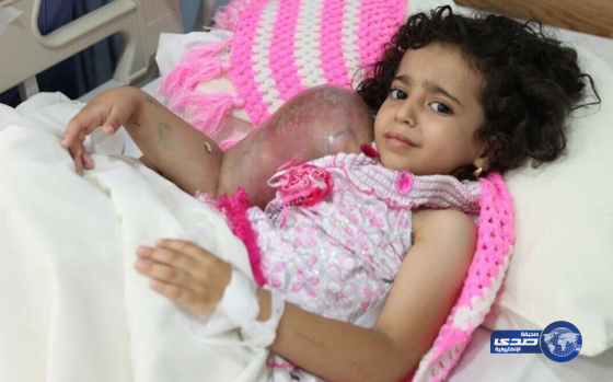 بالصور.. الطفلة اليمنية ريتاج وشقيقتها تصلان مستشفى الحرس الوطني بجدة