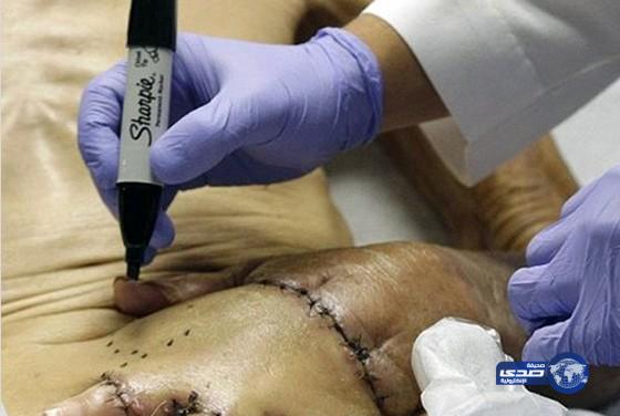 أطباء أمريكيون يربطون يد عجوز ببطنه