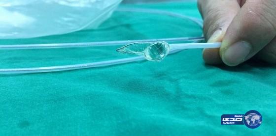 انتزاع ماسة مسروقة من مريء سائحة صينية في تايلاند