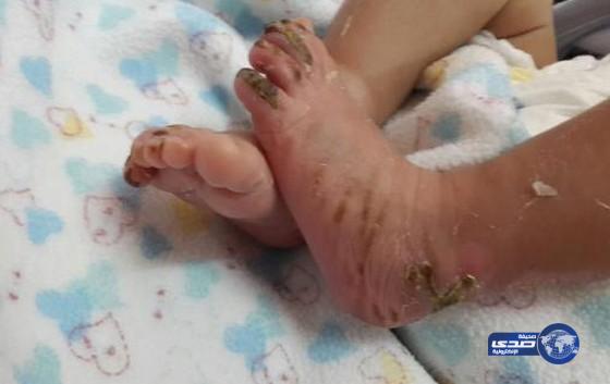 “الصحة” تكشف حقيقة إصابة مولود بحروق داخل مستشفى النساء والولادة بالجوف