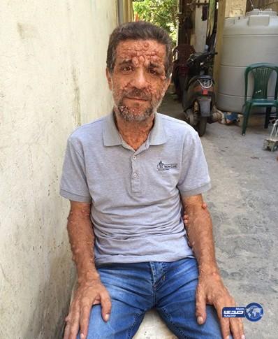 مرض جلدي نادر يحوّل حياة شاب لبناني إلى جحيم