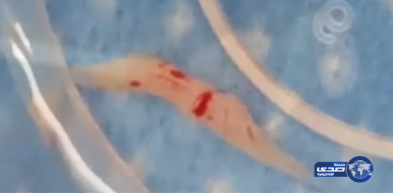 اكتشاف 8 يرقات في مخ سيدة(فيديو)