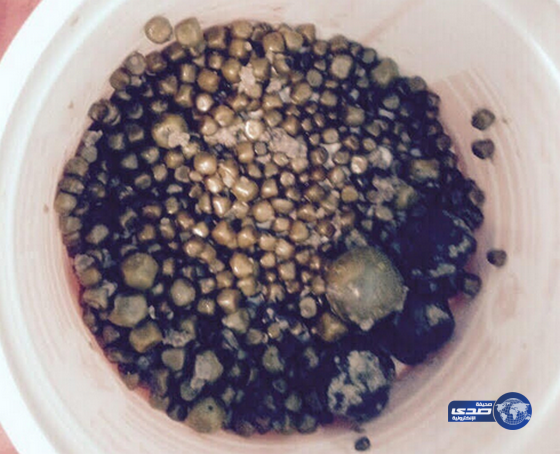 استخراج أكثر من ” 400 ” حصاة من مرارة مريضة سبعينية بمستشفى صبيا العام