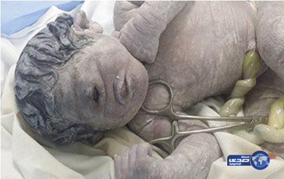 ولادة طفل بـ&#8221;عين واحدة&#8221; في منتصف الوجه في مصر