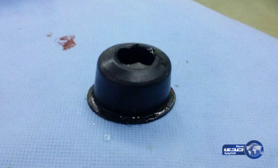 مستشفى بيشه يستخرج ” قطعة معدنية ” من بطن مريض