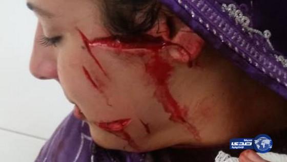 زوج يشرح وجه زوجته بعد كسبها دعوى الطلاق