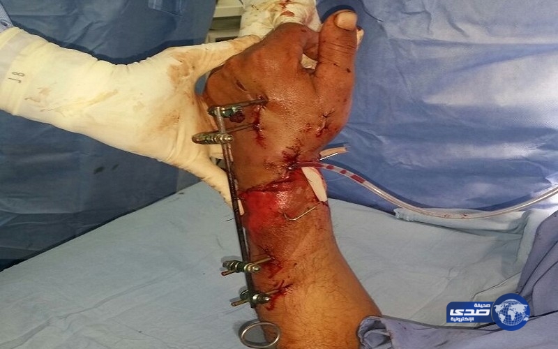 مستشفى السليل ينقذ يد مقيم من البتر