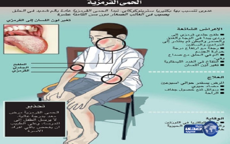 بريطانيا: زيادة حالات الإصابة بالحمى القرمزية