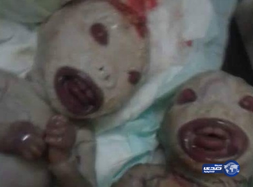 بالصور: مستشفى شهير في السودان يشهد أغرب حالة “إنجاب”