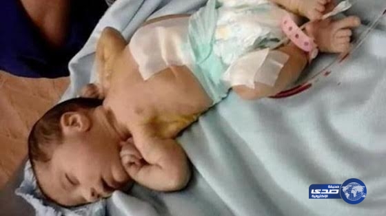 جنين بشعر وأسنان داخل بطن رضيعة عمرها 13 يوماً بمصر