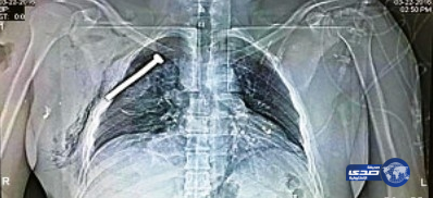 أشعة مثيرة لجريح بتفجيرات بروكسل يظهر فيها «مسمار»