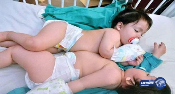 (مجلس علماء باكستان) يشكر المملكة بعد عملية فصل التوأم السيامي‎