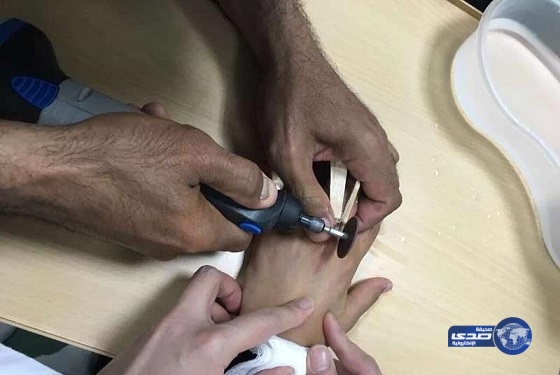 بالصور.. تحرير إصبع طفلة من خاتم صغير بمحافظة الغزالة