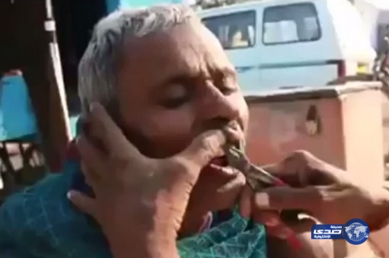 بالفيديو.. دكتور أسنان يعالج المرضى في الشارع باستخدام الكماشة