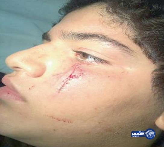 إنهاء عقد معلم إنجليزية شوه وجه طالب بـ «لكمة»