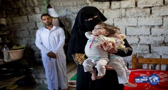 مصري يناشد الملك سلمان لإنقاذ ابنتيه السياميتين‎