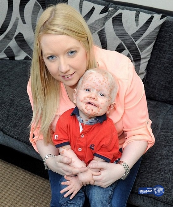 بالصور – بريطانية أصابتها صدمة نفسيه فأنجبت طفلاً بمرض نادر