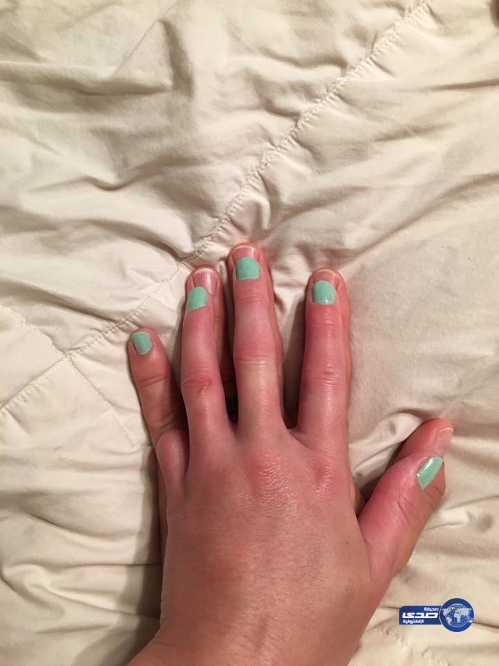 صور.. زوج يدعم زوجته بعد فقدان إصبع يدها: «منحها إصبعه»