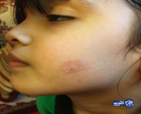 فصل المعلمة الآسيوية التي عاقبت طلابها بالكي بالنار