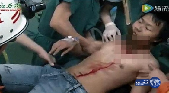 بالفيديو.. نجاة فتى من الموت بعد اختراق قضيب لصدره