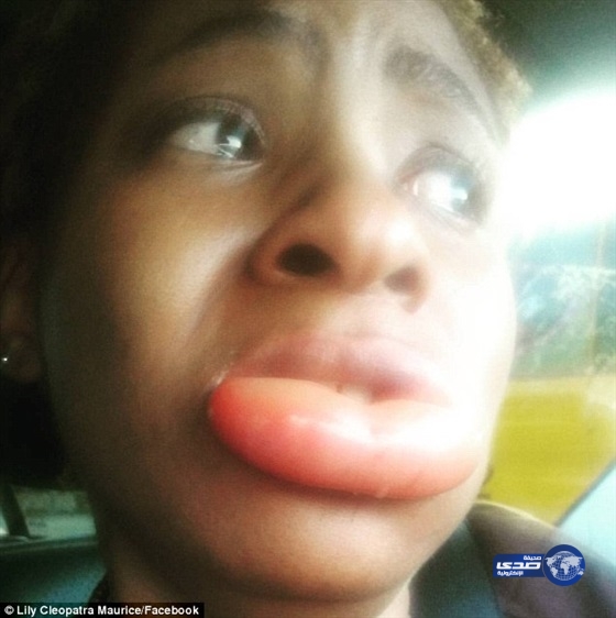 بالفيديو والصور.. أحمر شفاه يشوه امرأة