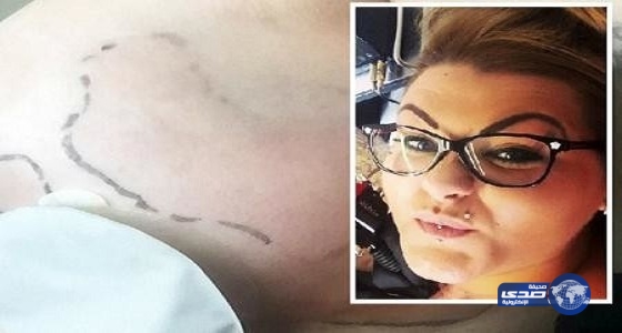 بريطانية قرّرت تكبير صدرها  بعملية فانفجر