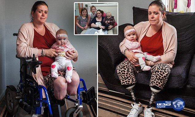 دخلت لتلد بعملية قيصريّة… فخرجت مبتورة القدمين!