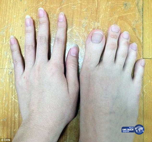بالصور.. فتاة تحير العالم بأصابع قدميها