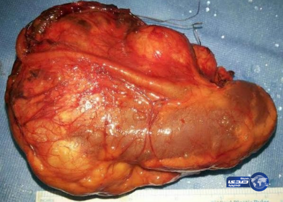 بالصور: استئصال ورم سرطاني ضخم من كلية طفلة في الطائف