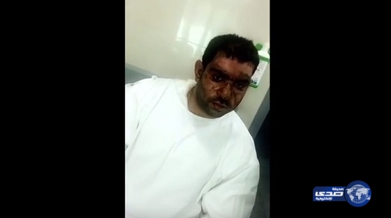 بالفيديو.. انفجار شاحن في وجه شاب كويتي أثناء نومه